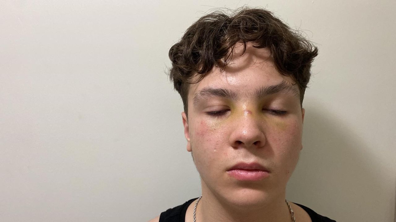Lise çıkışındaki kavgada 14 yaşındaki öğrencinin burnu kırıldı