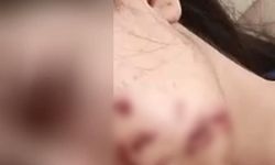 Yüzüne maytap isabet eden genç kız yaralandı