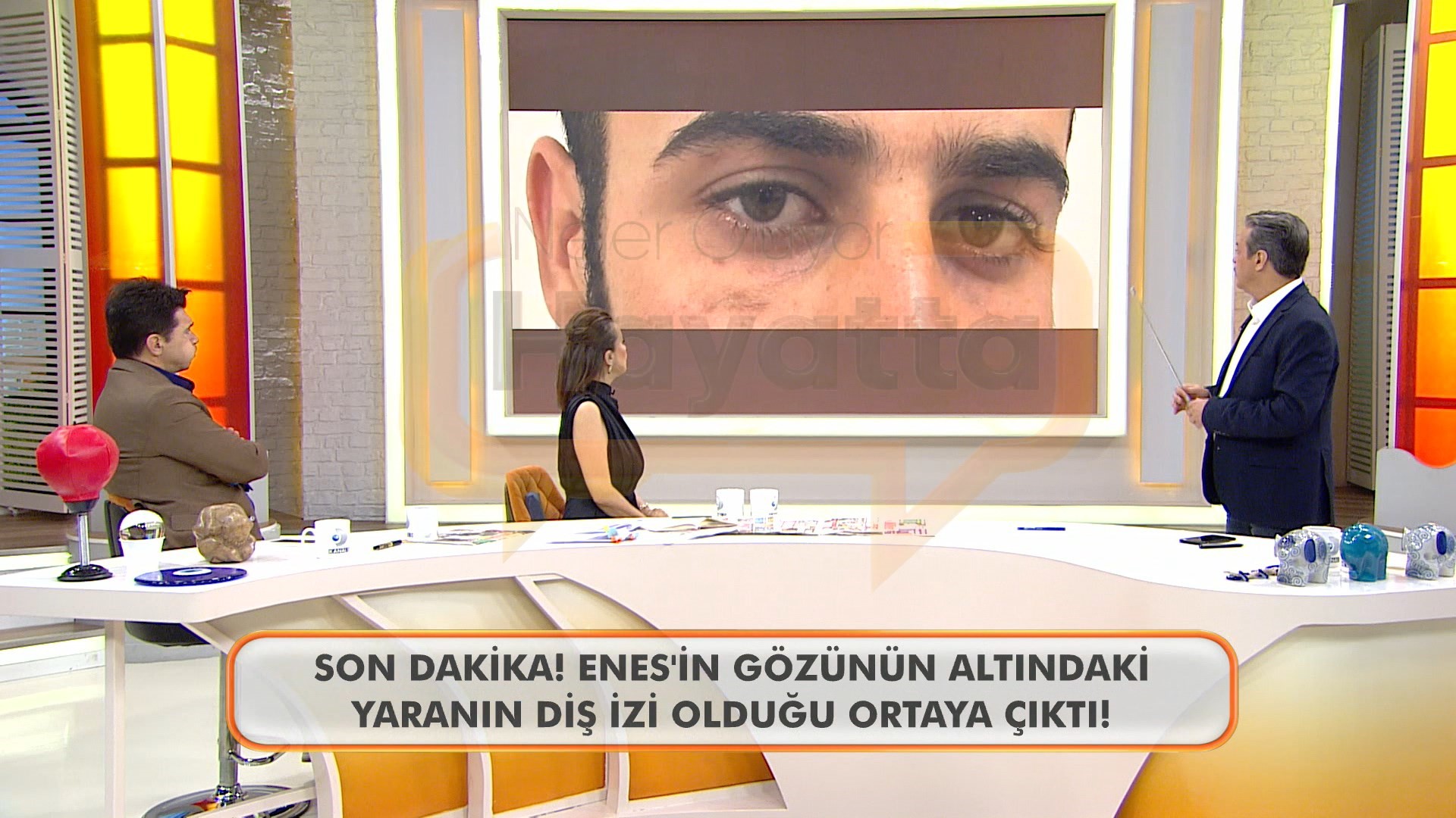 Enes Güran’ın Gözünün Altındaki Diş Izi (1)