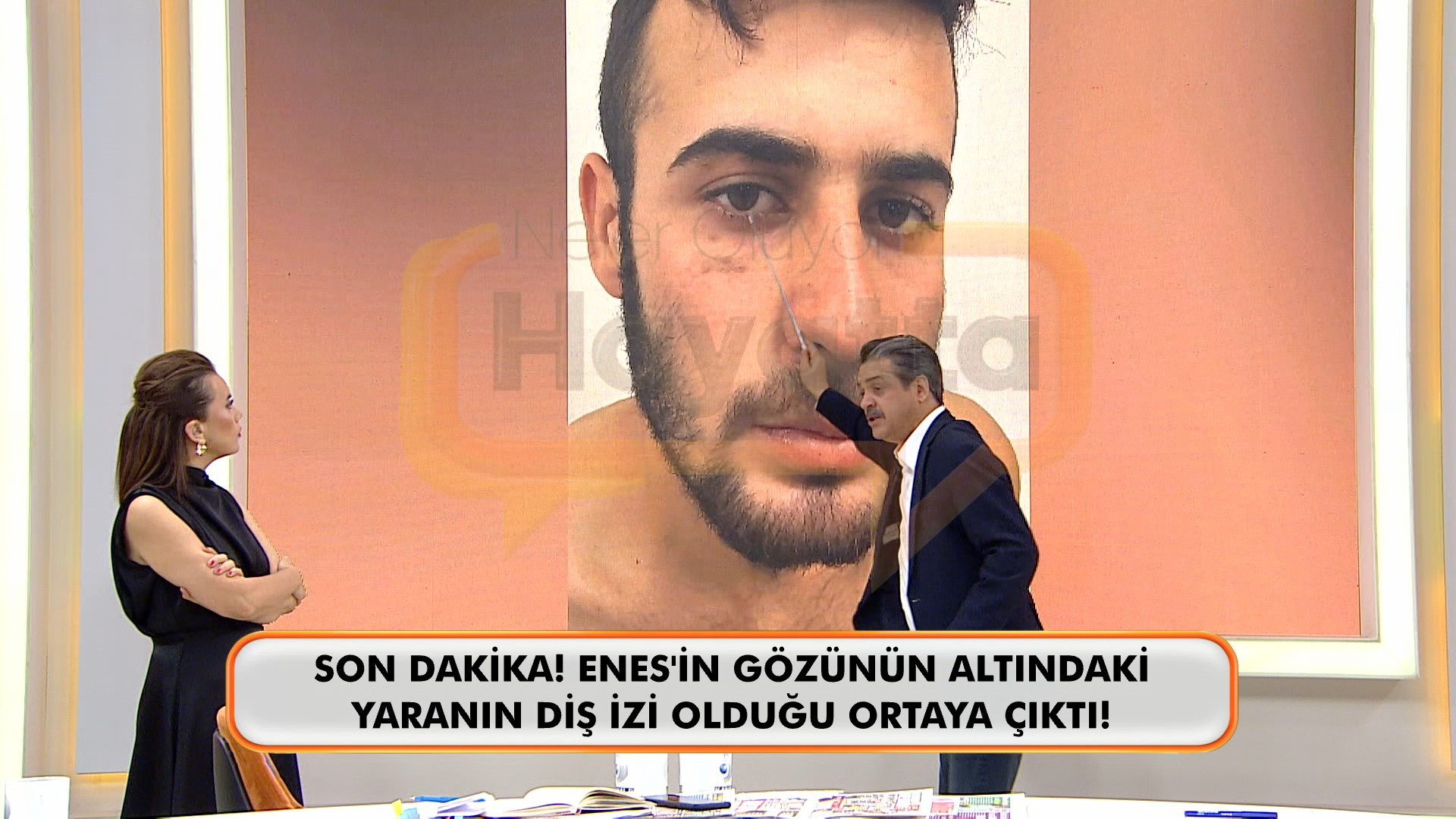 Enes Güran’ın Gözünün Altındaki Diş Izi (2)